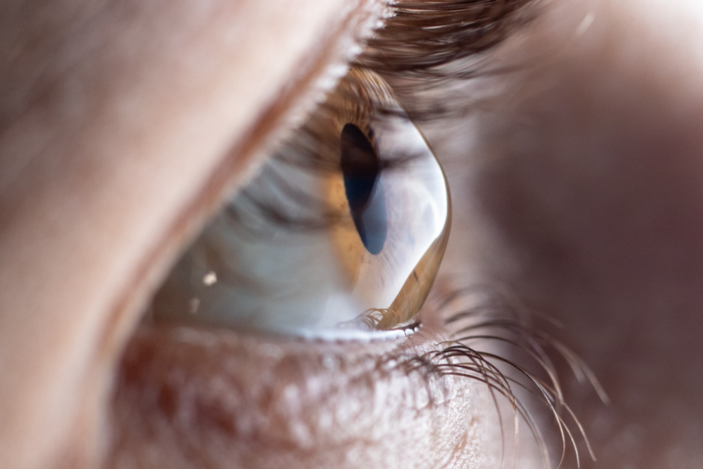 Junho Violeta: campanha alerta para o risco de coçar os olhos e a progressão do ceratocone