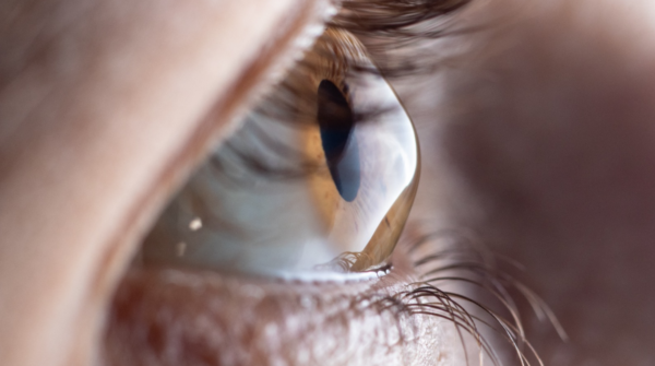 Junho Violeta: campanha alerta para o risco de coçar os olhos e a progressão do ceratocone